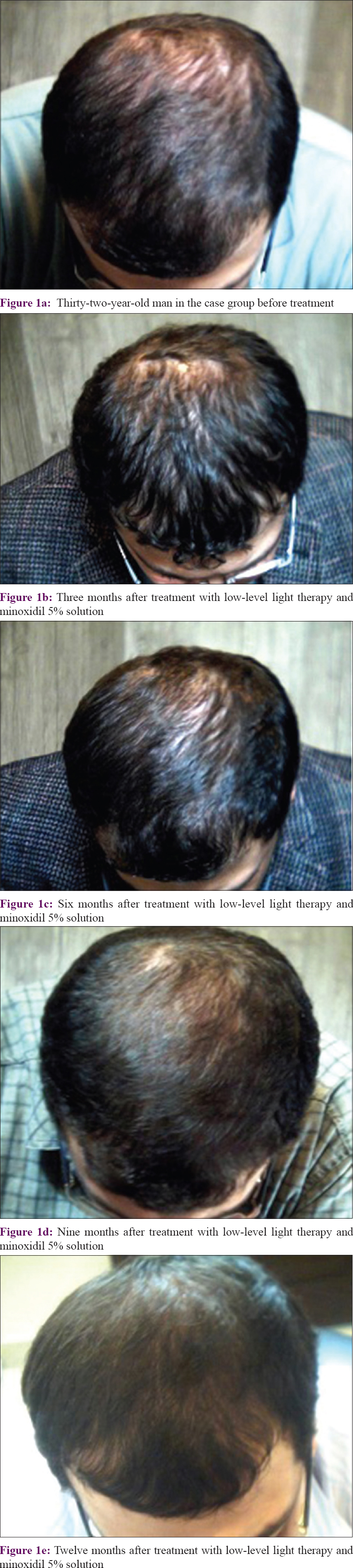 The effectiveness of adding low-level therapy to minoxidil 5% solution in the treatment of with androgenetic - Indian Journal of Dermatology, Venereology Leprology