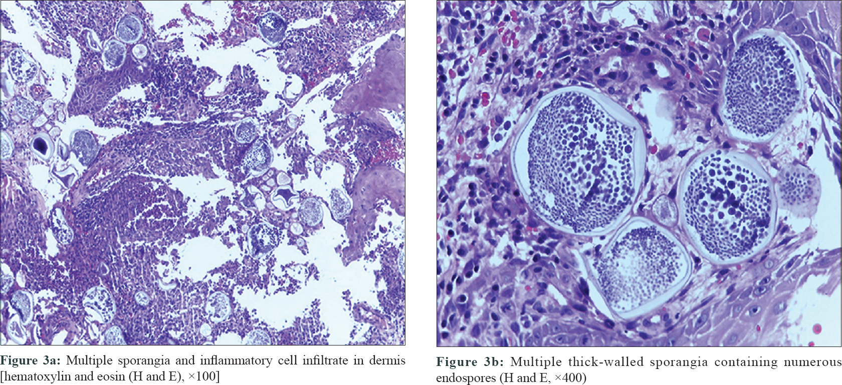 Indian Journal Of Dermatology Venereology And Leprology Polymorphic Presentation Of 7359