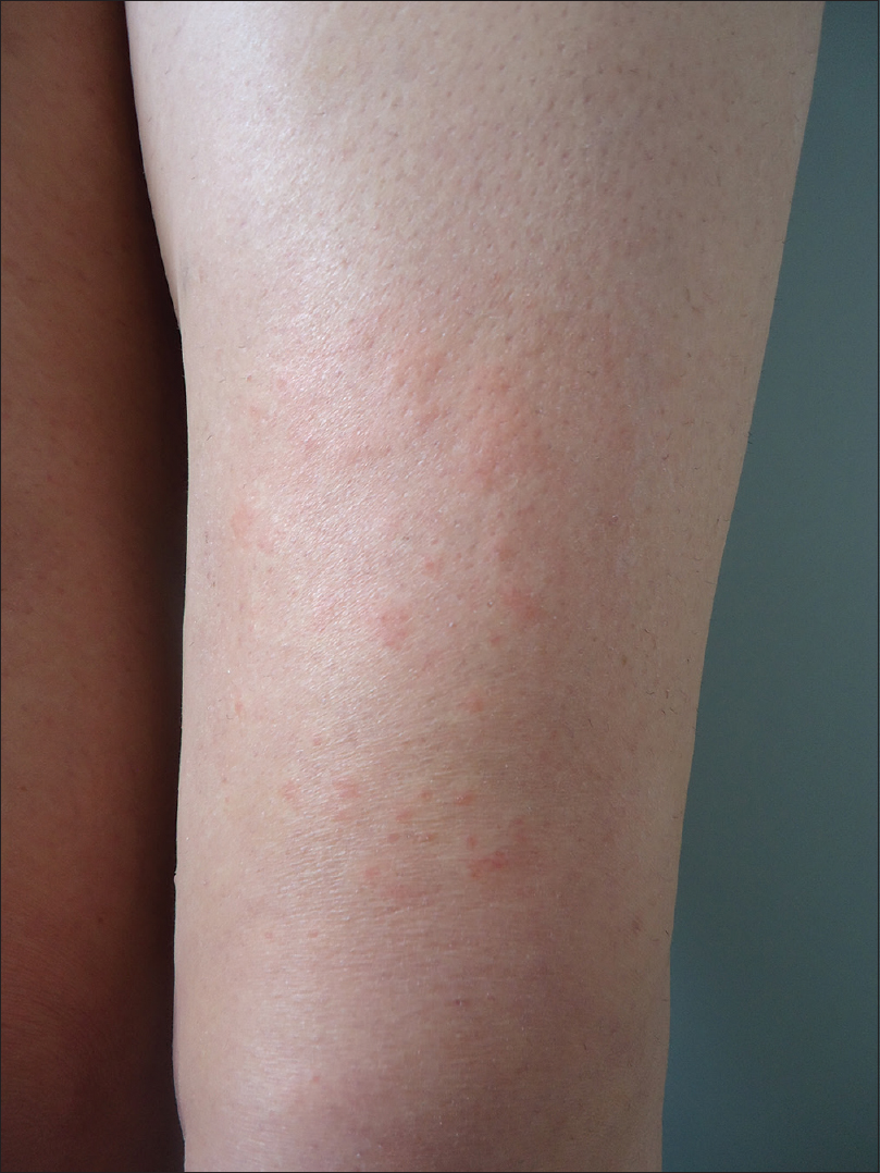 Adverse cutaneous events after laser epilation in patients with