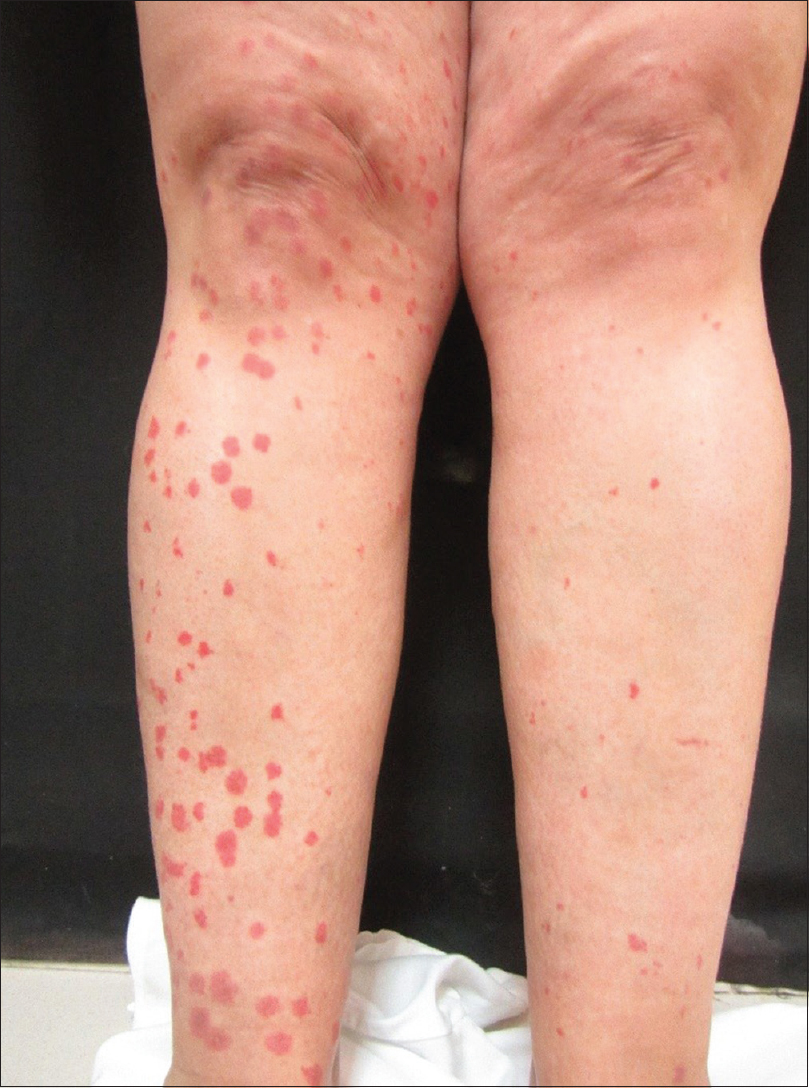 Adverse cutaneous events after laser epilation in patients with