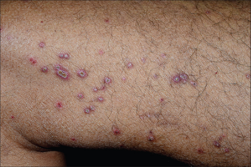 perforating folliculitis