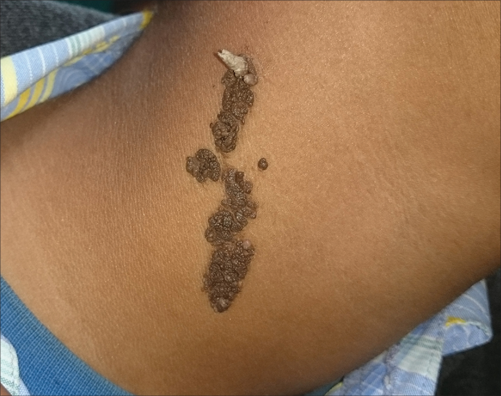 epidermal nevus