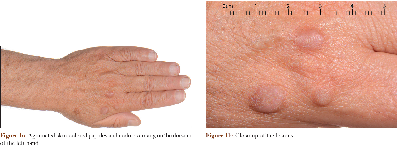 Bilateral agminated skin-colored papules and nodules on the dorsum of ...