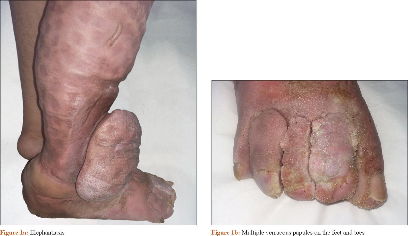 Osteoma cutis - Altmeyers Enciklopédia - Bőrgyógyászati ​​Osztály