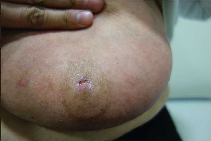 Right breast at initial presentation. Erosion and redness of the nipple