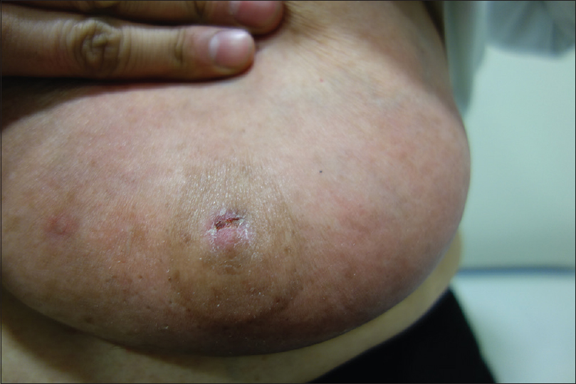 Thickening of skin and plaques on a man's nipples and areolas