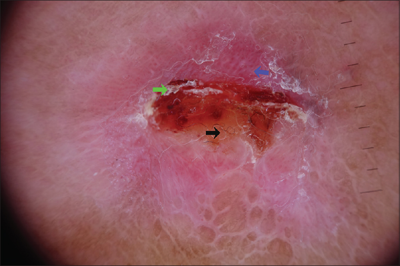 Nipple adenoma in a female patient presenting with persistent