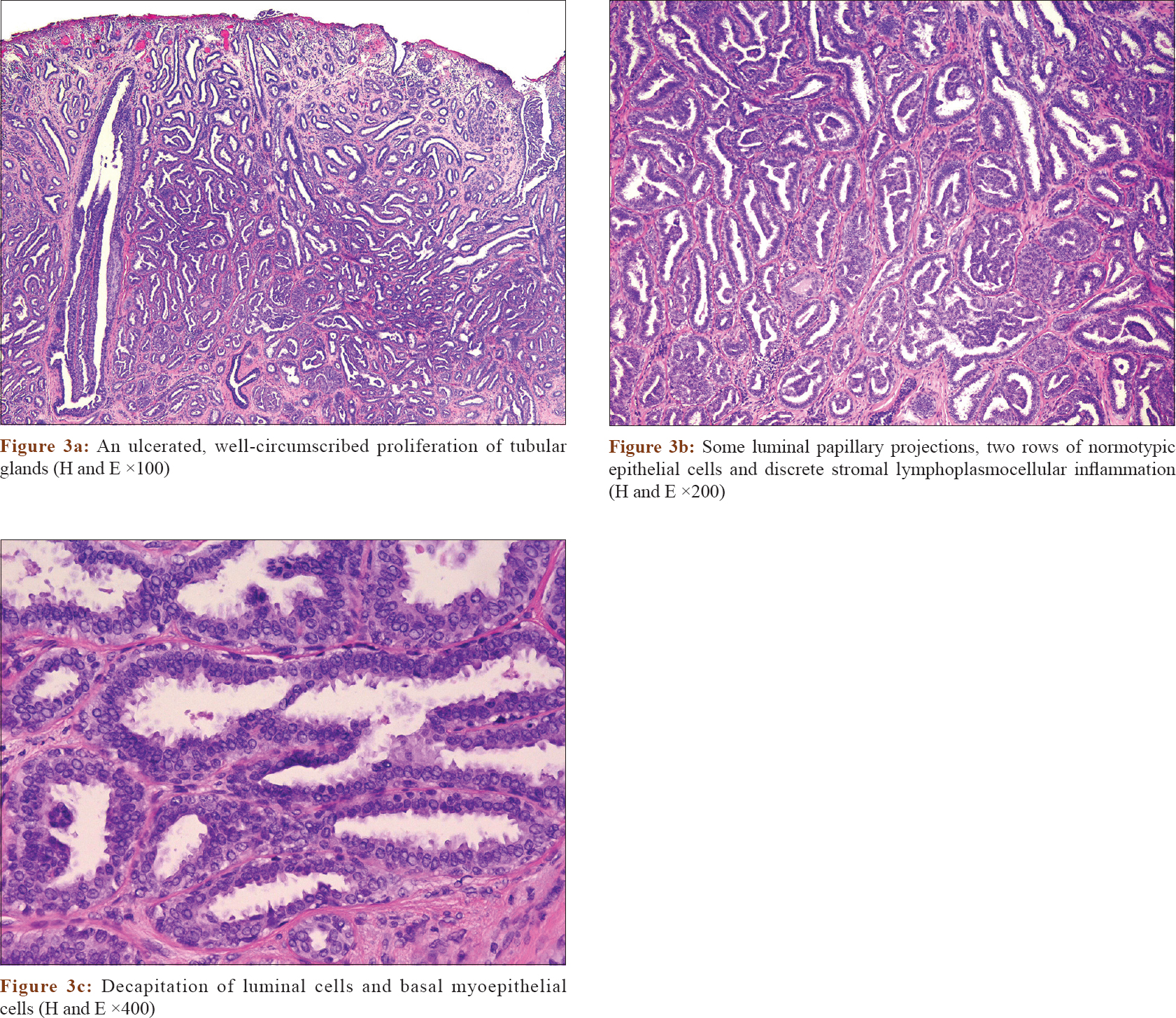 Nipple adenoma in a female patient presenting with persistent erythema of  the right nipple skin: case report, review of the literature, clinical  implications, and relevancy to health care providers who evaluate and