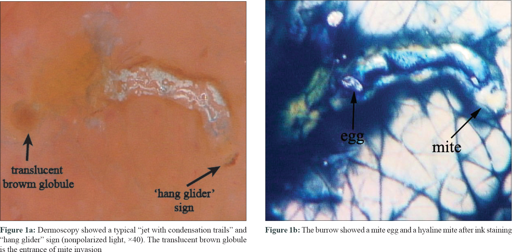 Scabies Dermoscopy