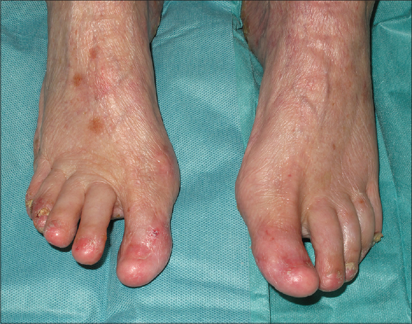 Ulcerative Lichen Planus Foot