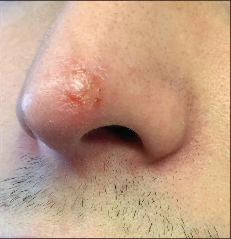 ringworm nose