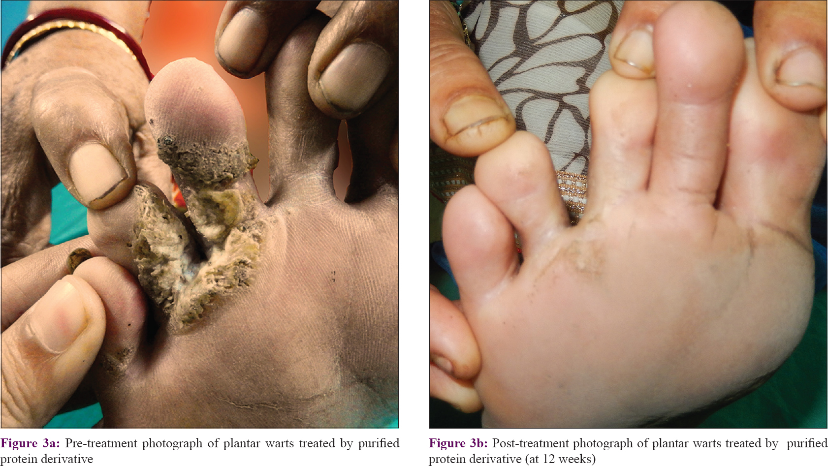 A Double Blind Randomized Controlled Trial To Compare The Effectiveness And Safety Of Purified Protein Derivative Of Tuberculin Antigen With I Mycobacterium W I Vaccine In The Treatment Of Multiple Viral Warts Indian Journal