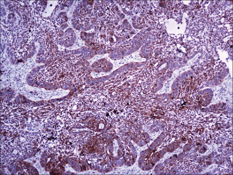 adenoid basal cell carcinoma histology