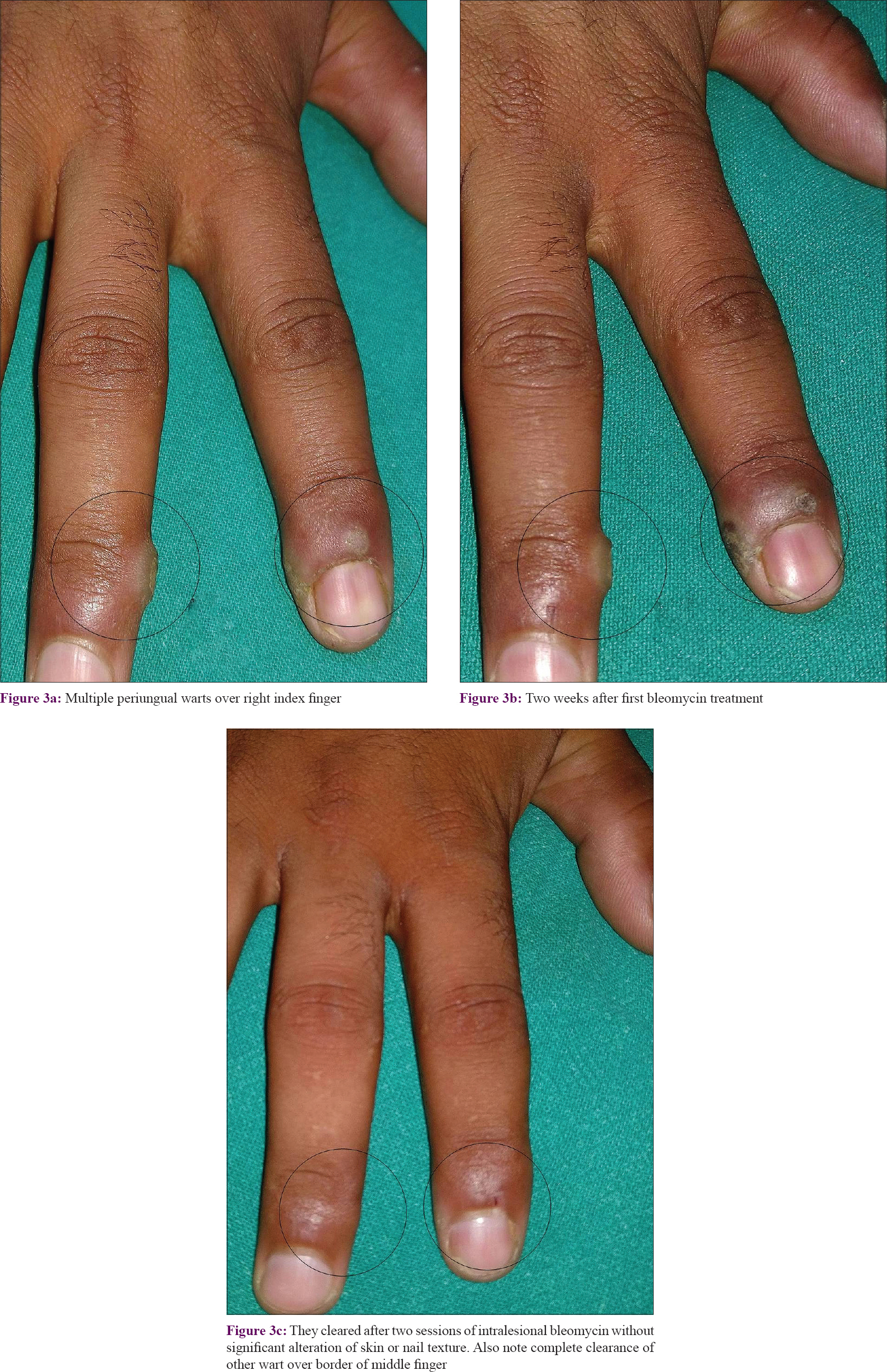 warts on hands treatment