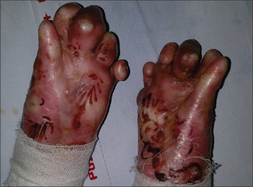 epidermolysis bullosa dystrophica