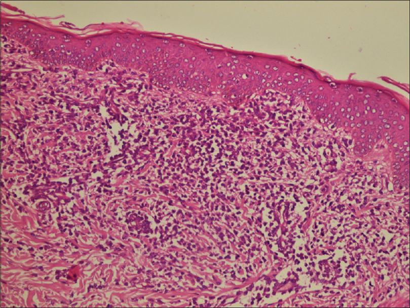 Urticaria Pigmentosa Histology