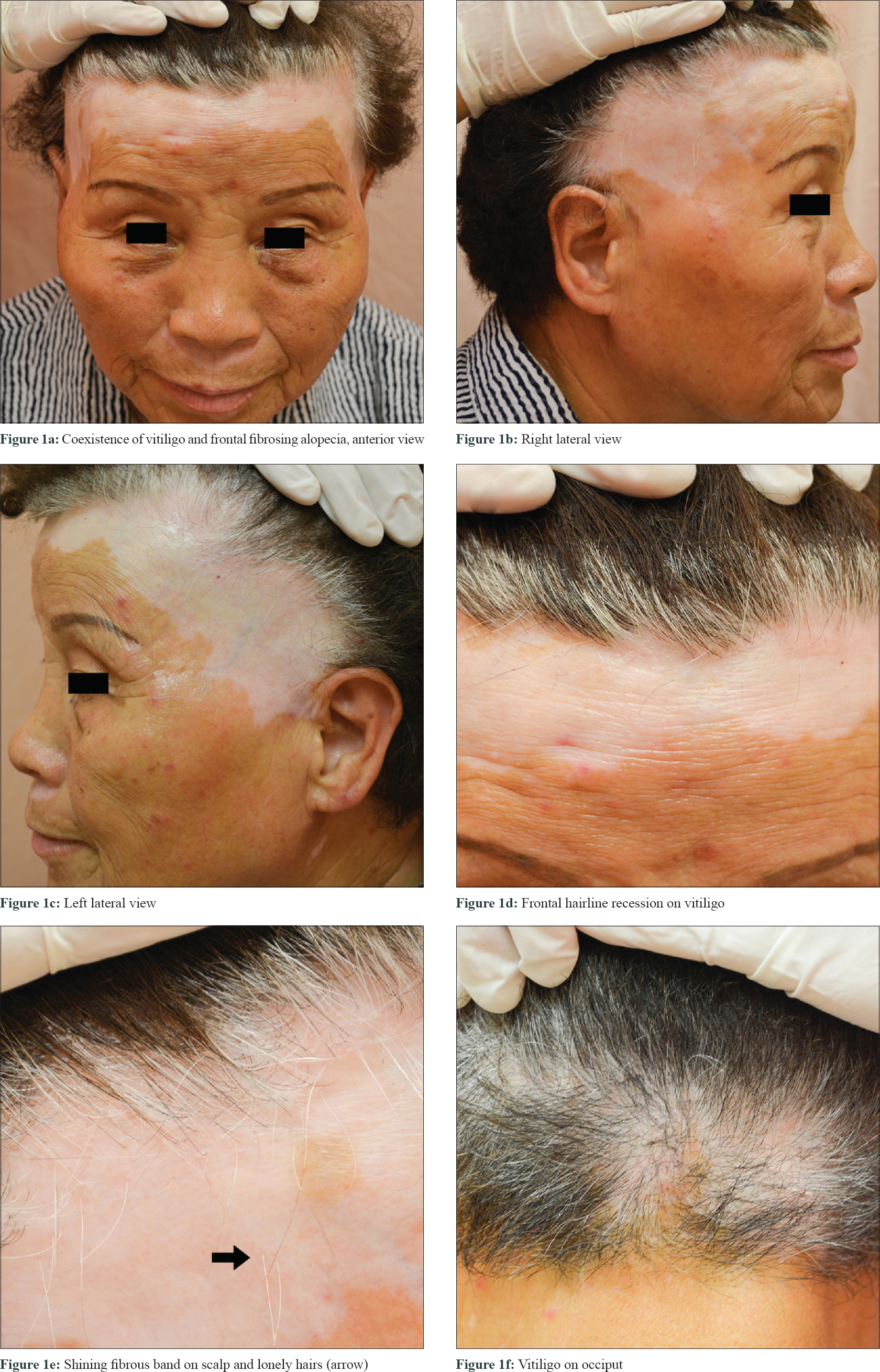 Frontal fibrosing alopecia developing on vitiligo - Indian Journal of  Dermatology, Venereology and Leprology
