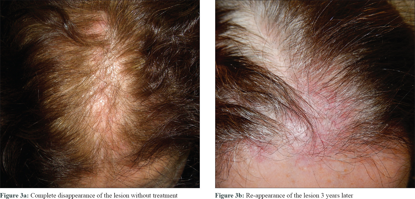 Macular presentation of primary cutaneous follicle center lymphoma with ...