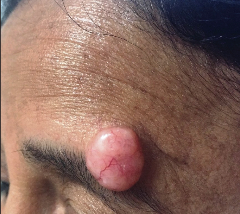 solitary trichoepithelioma