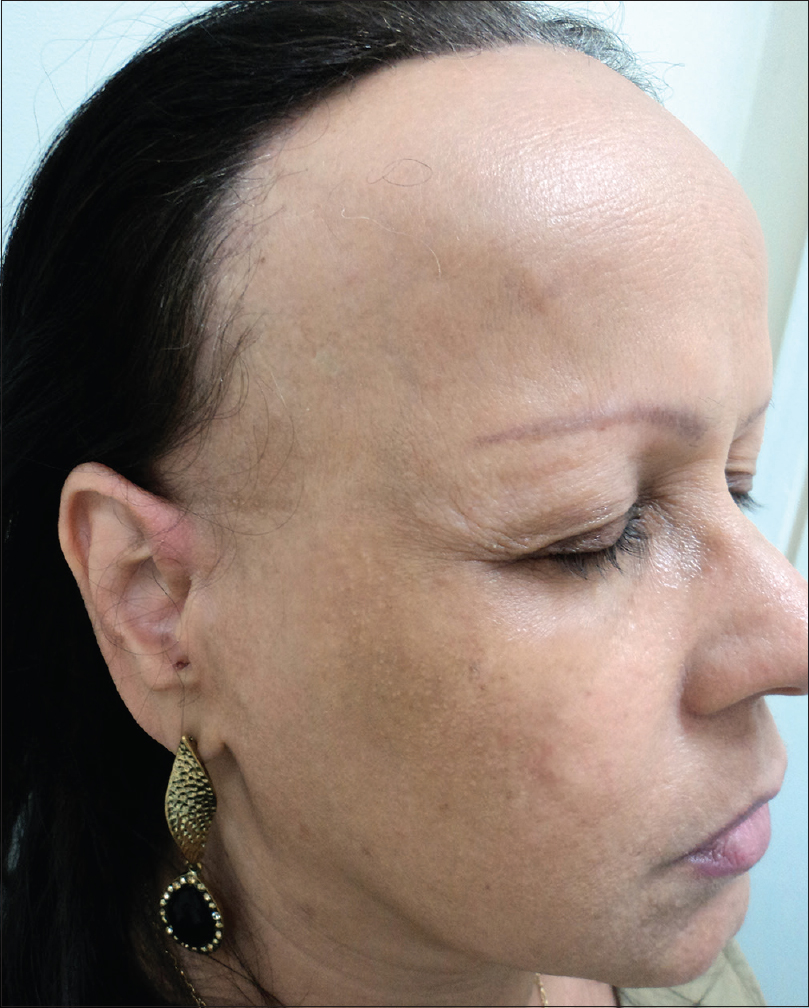 Hairpiece or Topper for Frontal Fibrosing Alopecia FFA  YouTube