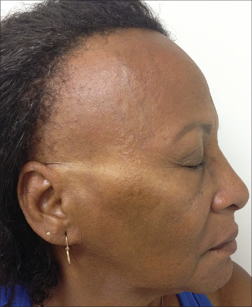 Frontal Fibrosing Alopecia in Women The Mayo Clinic Experience With 148  Patients 19922016  ScienceDirect