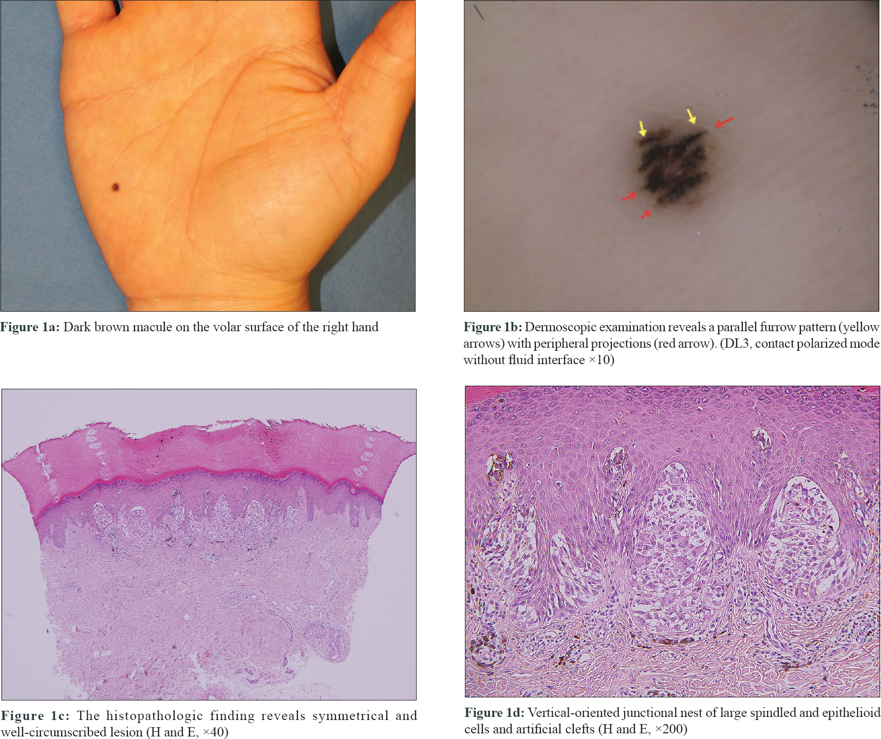 junctional nevus foot