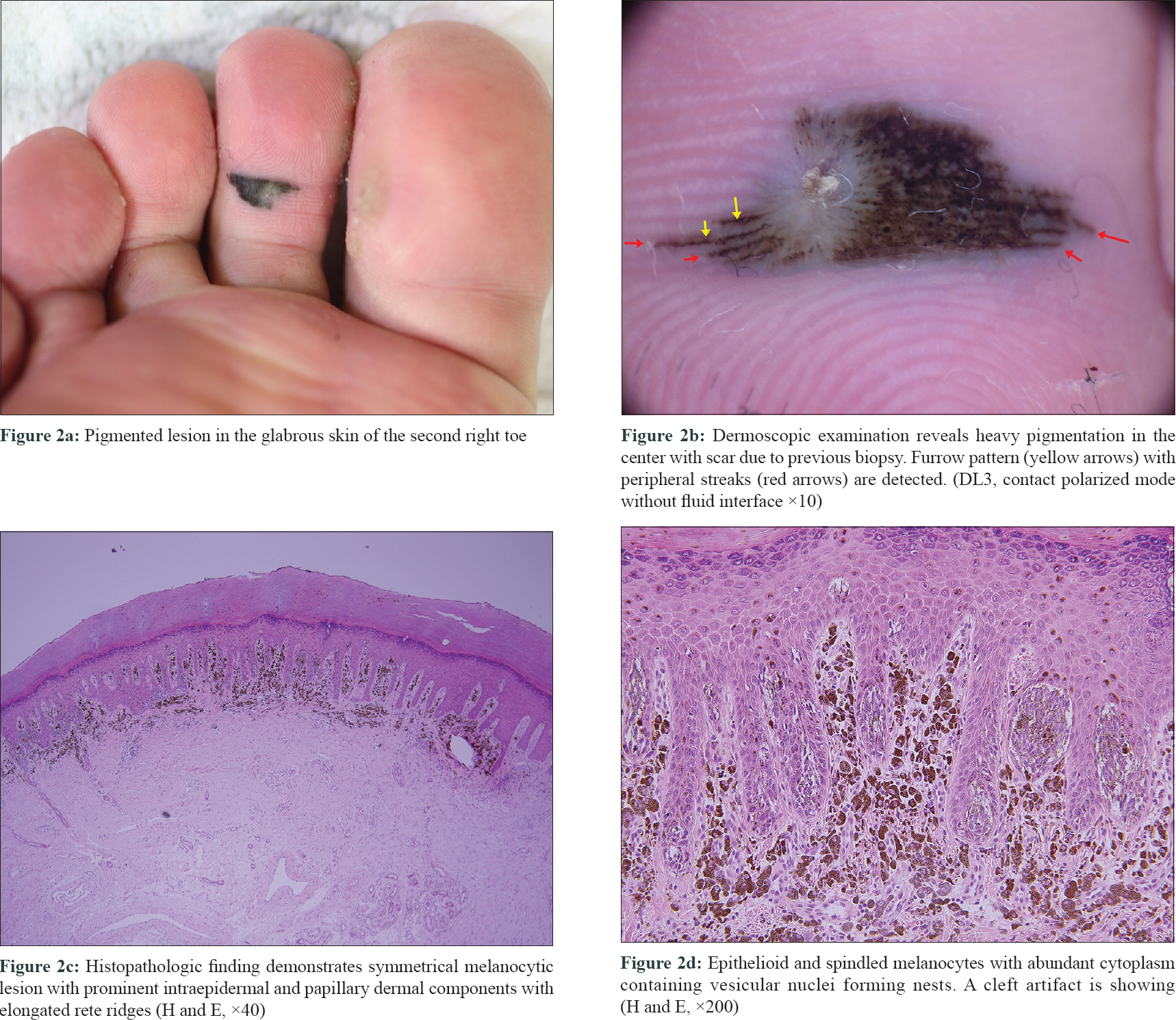 junctional nevus foot