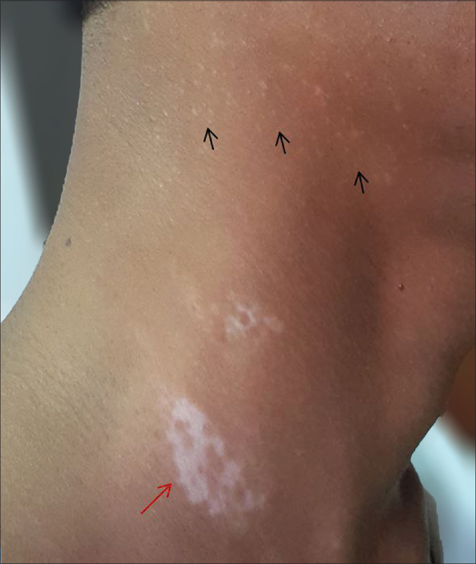 The Diagnosis: Trichrome Tinea Versicolor