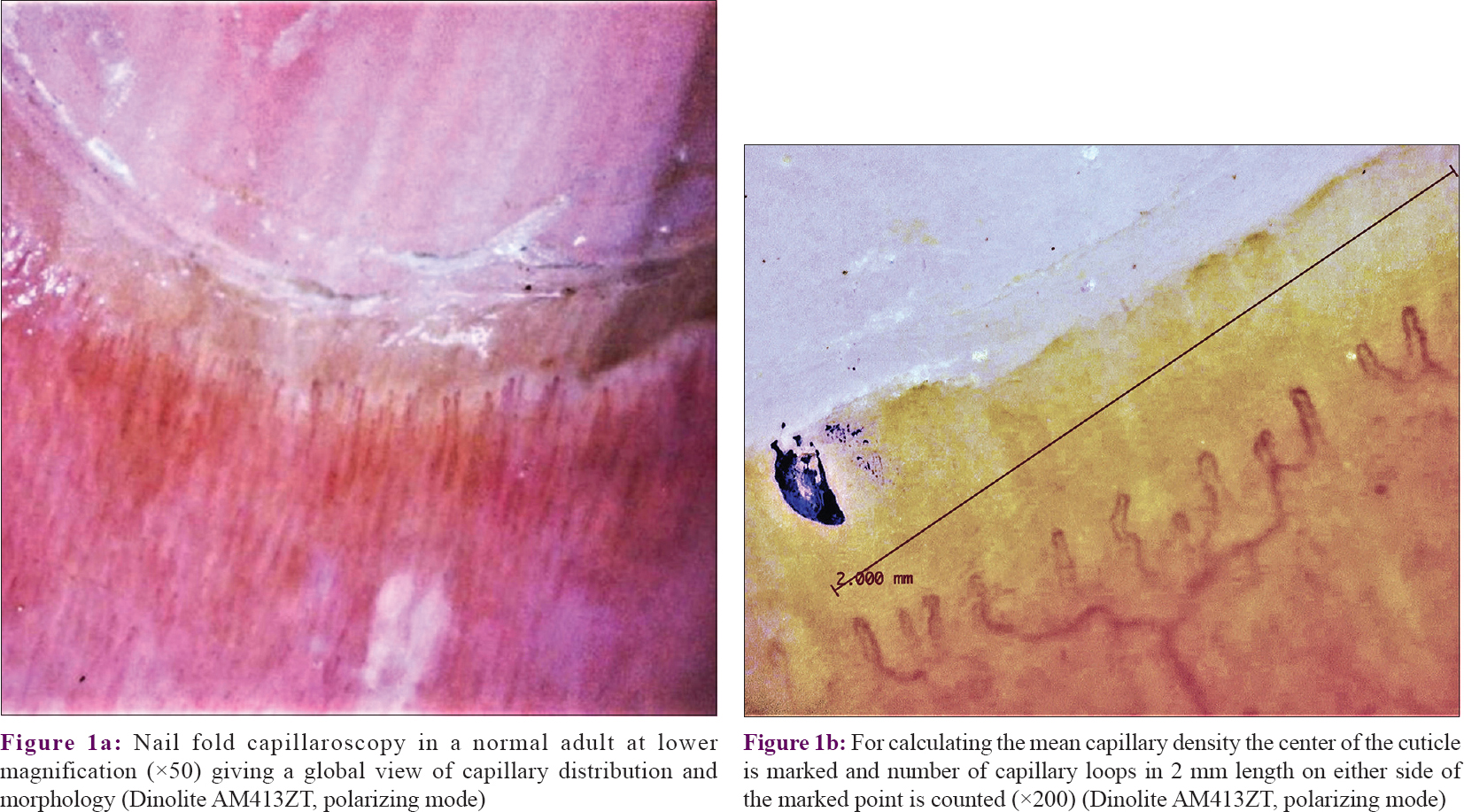 Nail Fold Capillaries