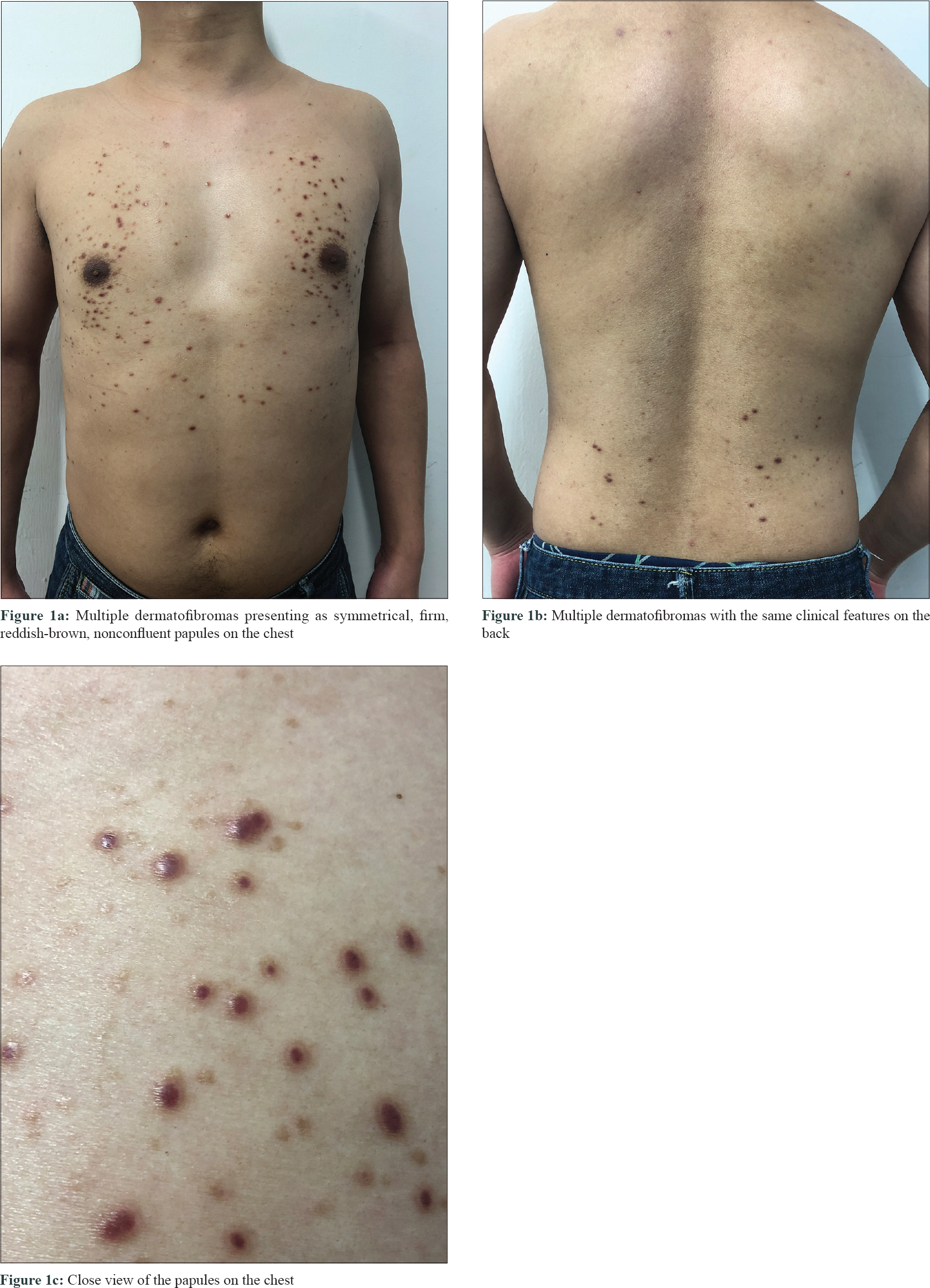 Pathology Outlines - Dermatofibroma (cutaneous fibrous histiocytoma)