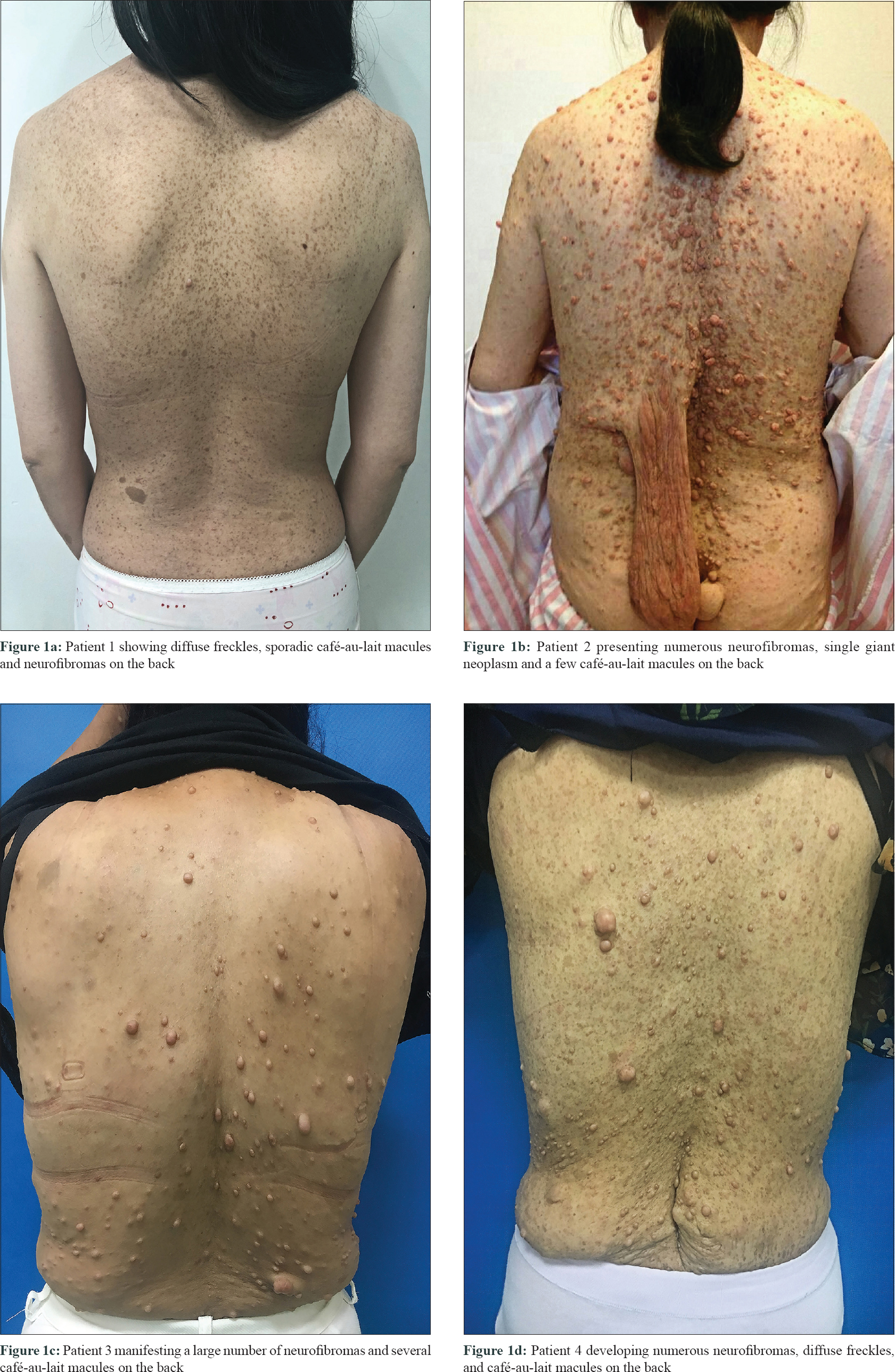 Two Novel Mutations Of Nf1 Gene Identified In Chinese Patients With Severe Neurofibromatosis Type 1 Indian Journal Of Dermatology Venereology And Leprology