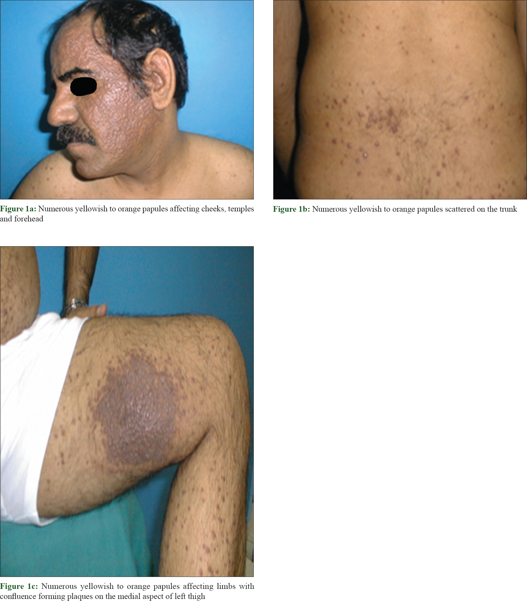 A New Presentation Of Isolated Cutaneous Rosai Dorfman Disease Eruptive Xanthoma Like Lesions 6921