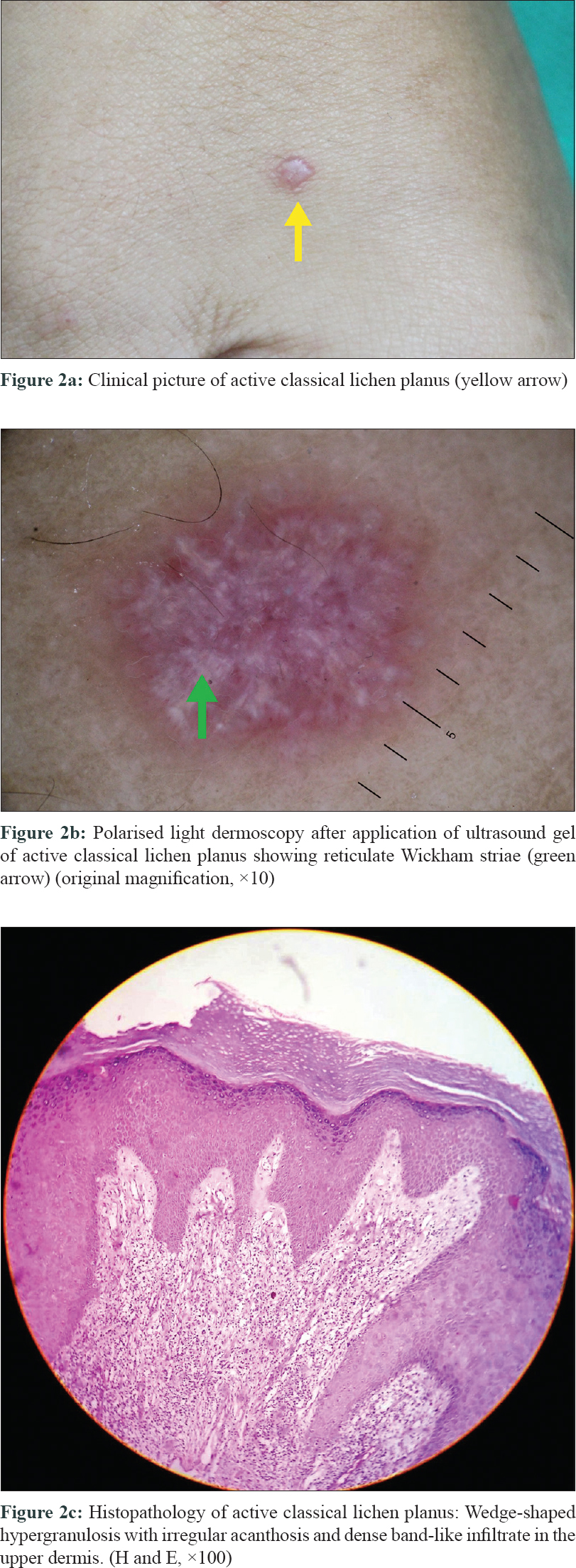 Actinic Lichen Planus