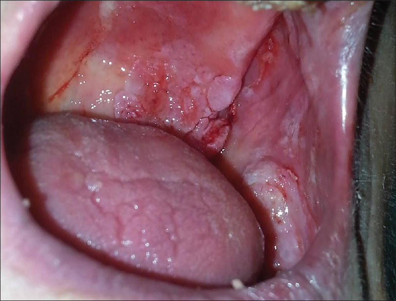 verrucous carcinoma palate