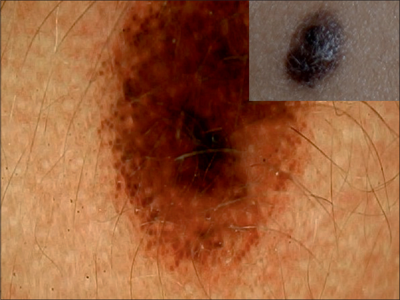 junctional melanocytic nevus