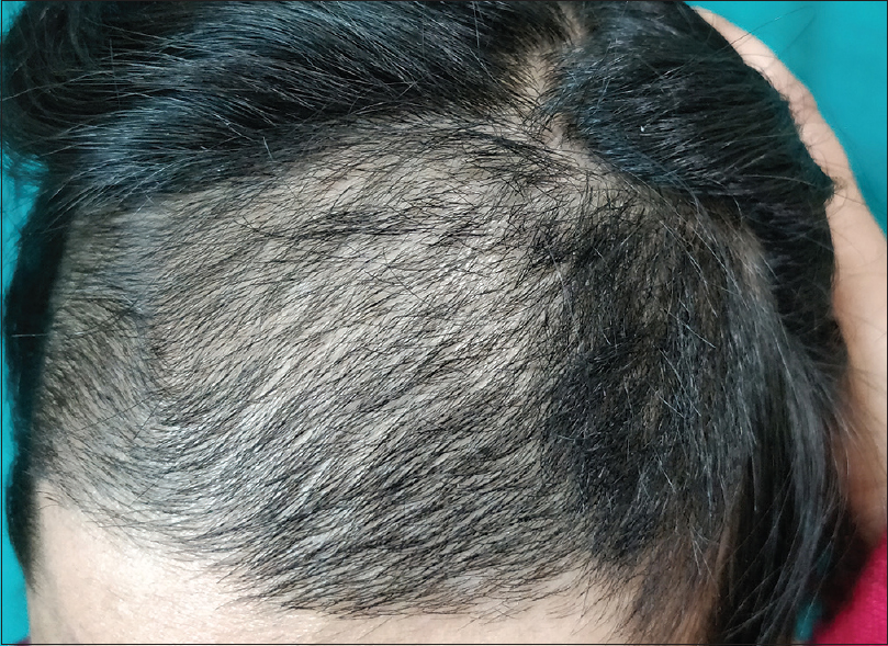 Does pulled hair from grow back Trichotillomania Hair Regrowth Tips