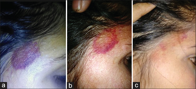 Ecchymosis