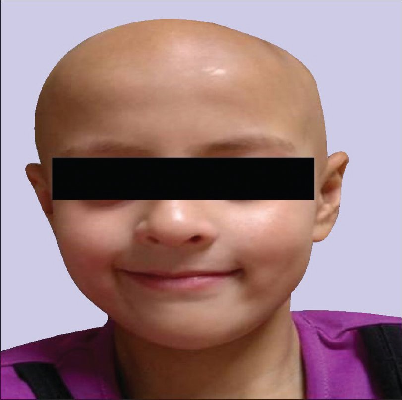 alopecia universalis causes