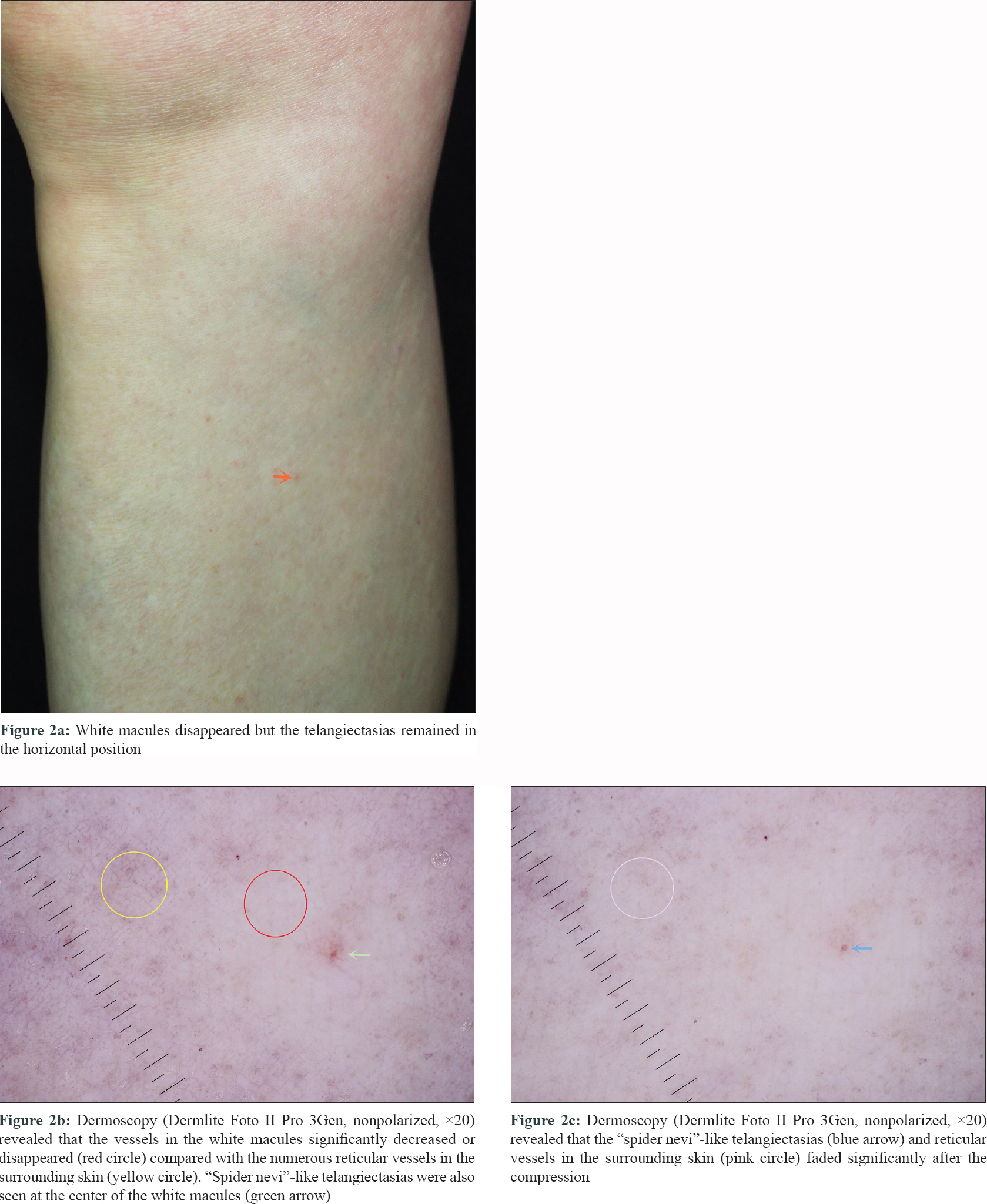 telangiectasia chest