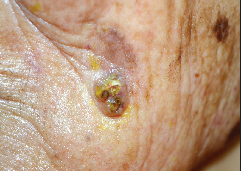 atrophic actinic keratosis