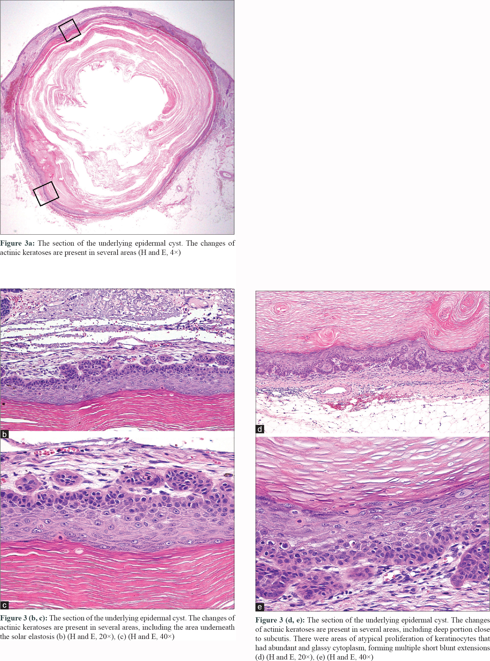 atrophic actinic keratosis