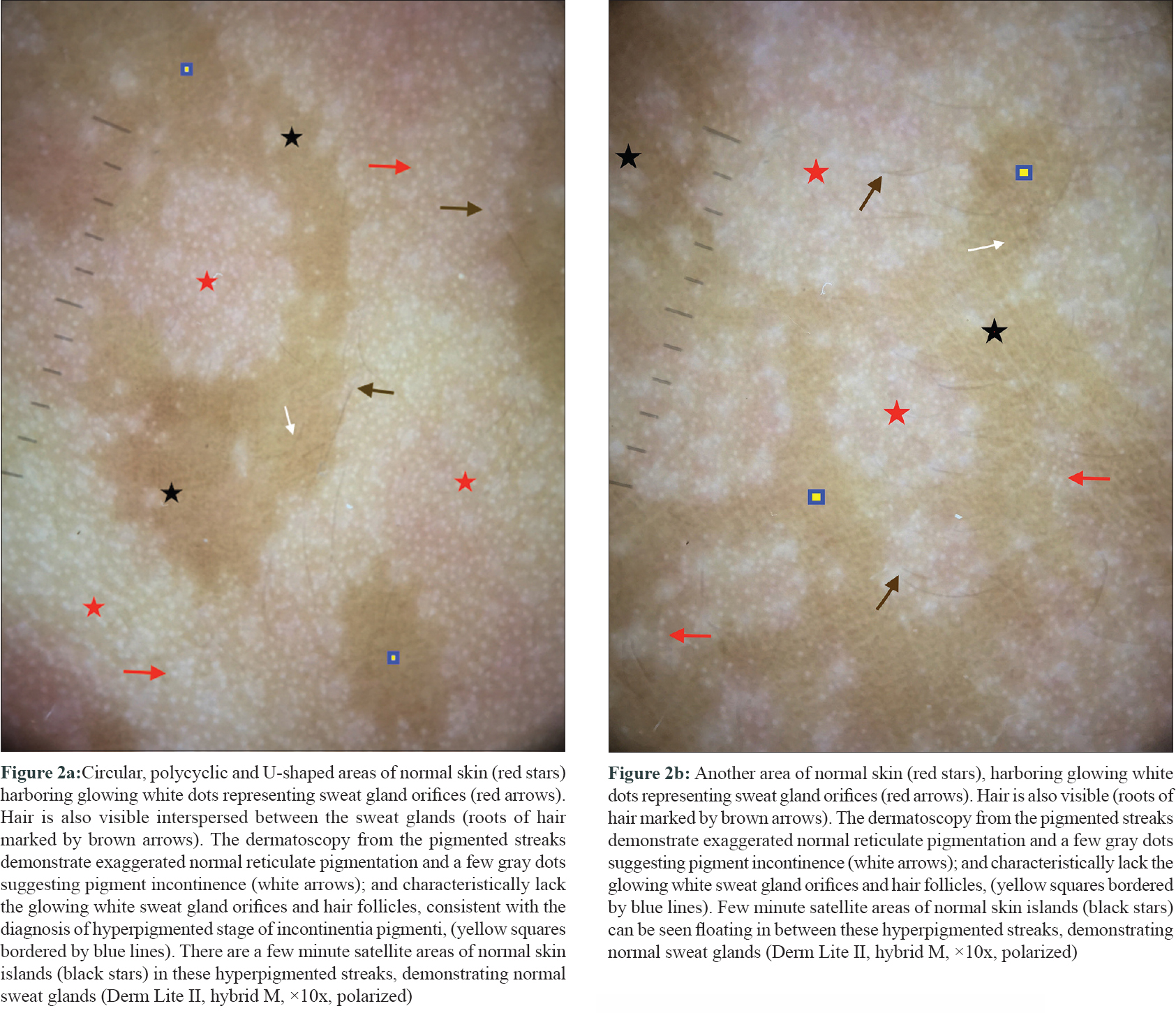 Indian Journal Of Dermatology Venereology And Leprology Dermatoscopic Features Of