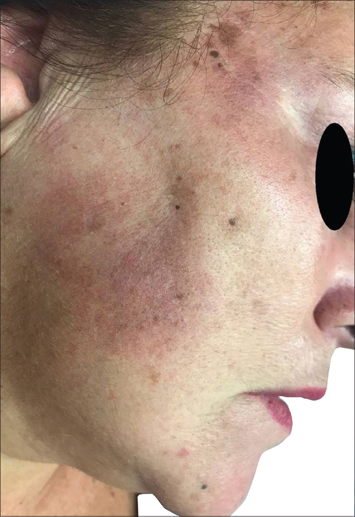 Skin Discoloration With Lupus: Red Spots, Orange Spots, and More