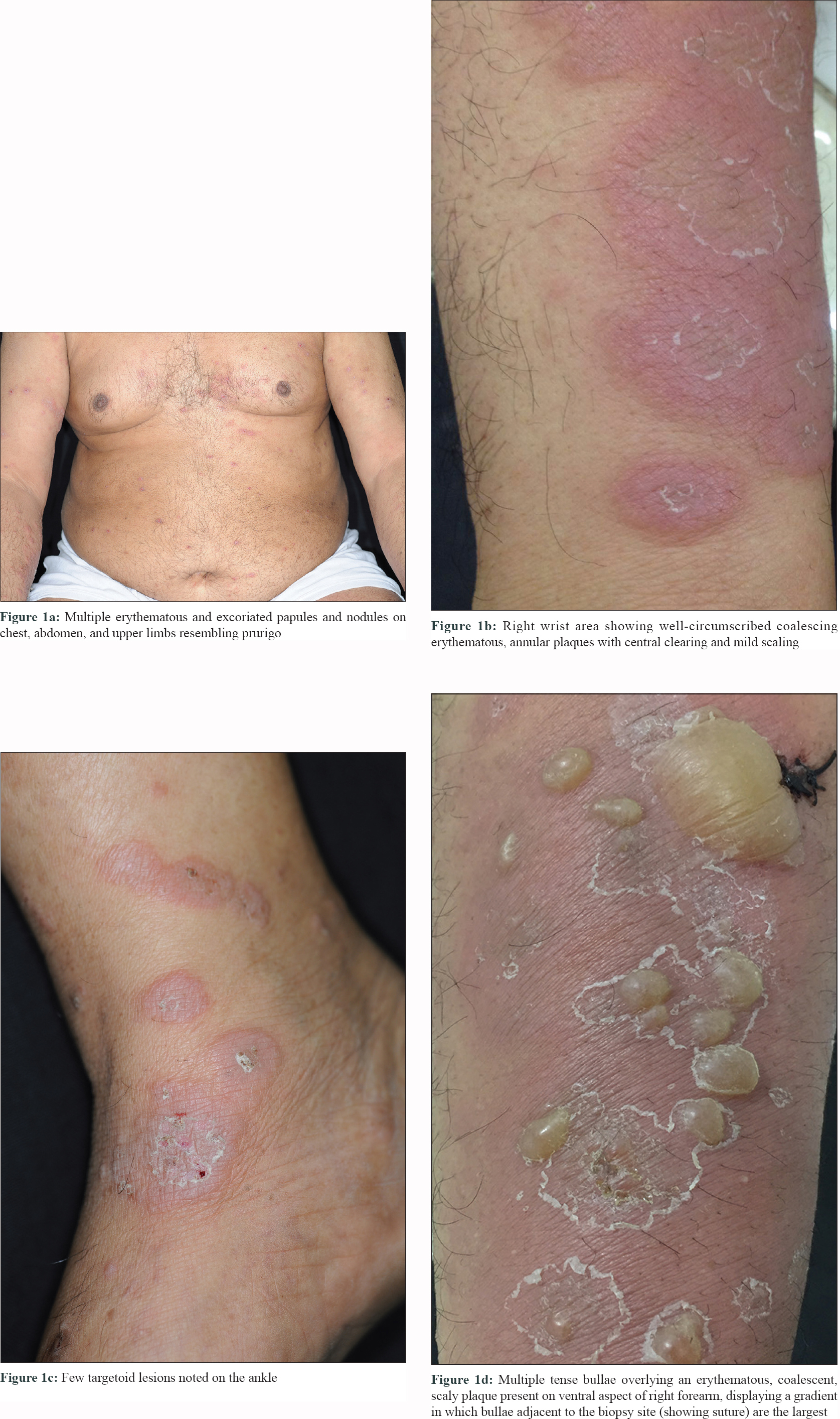 bullous pemphigoid