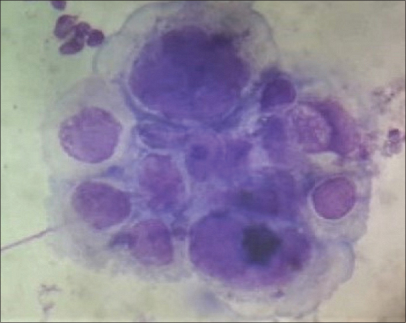 Tzanck Smear Multinucleated Giant Cells