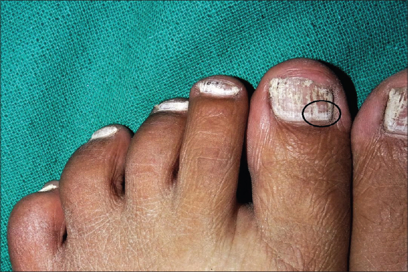 Practical Pearls in Cutaneous Fungal Infections and Onychomycosis