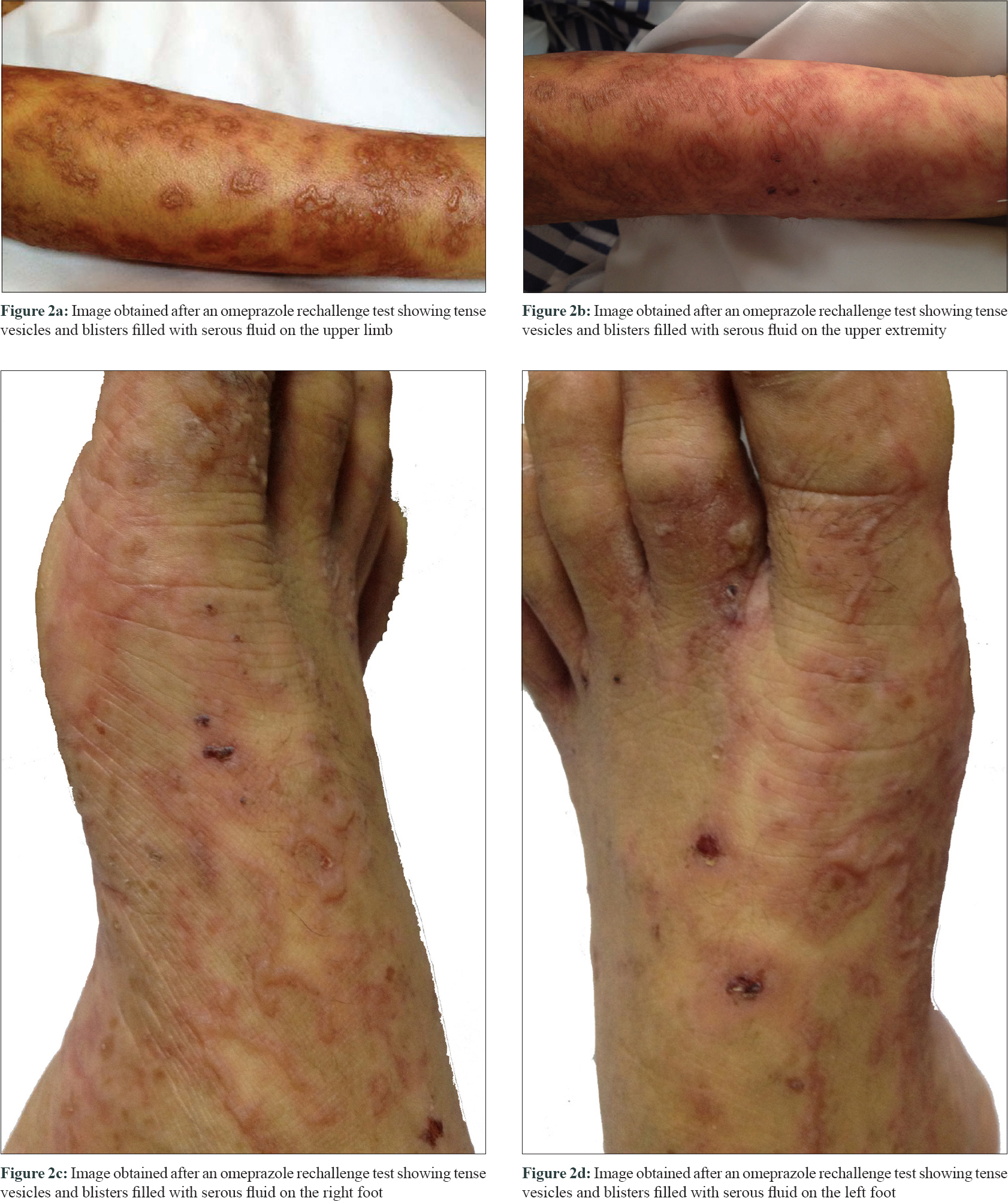 Clinical photograph of linear IgA bullous dermatosis showing tense