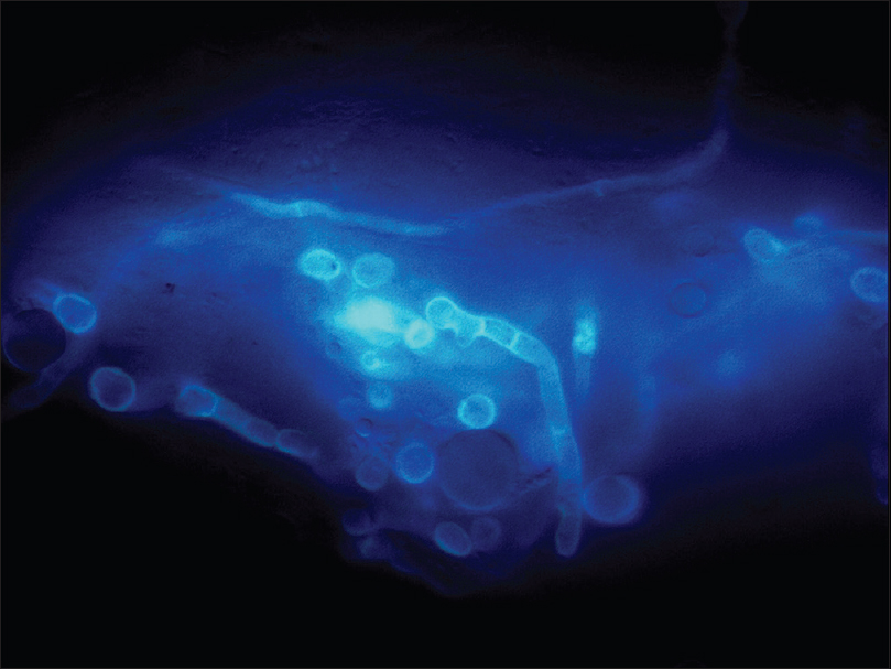 Correlation between dermoscopy and direct microscopy in Tinea