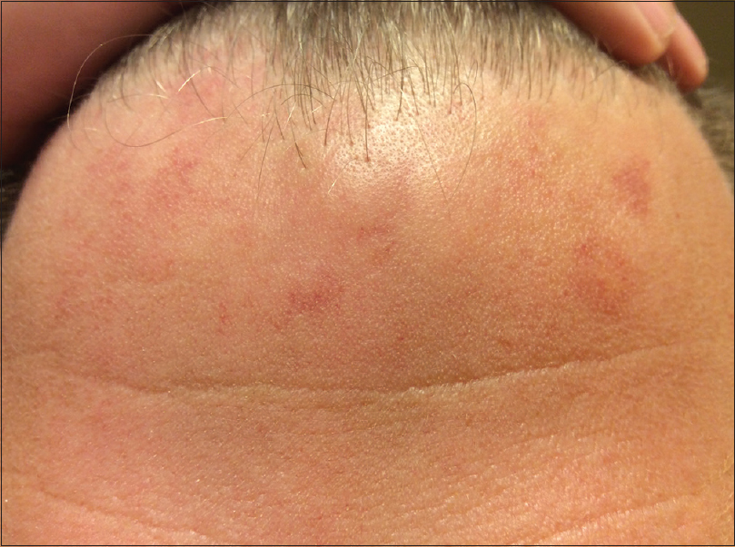 Red Forehead Dots And Migraine Indian Journal Of Dermatology