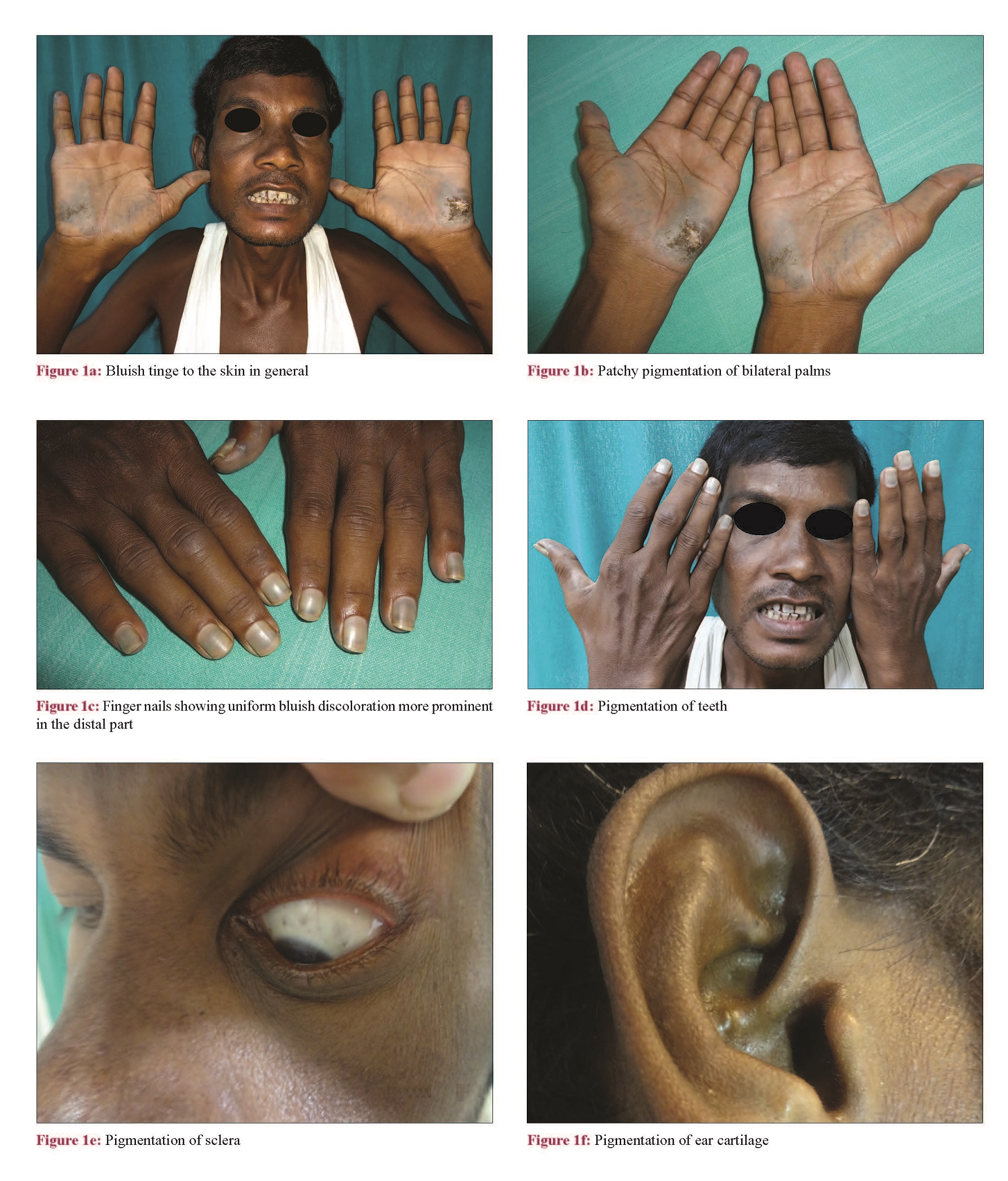 Blue palms and nails: A clue to diagnosis of alkaptonuria - Indian ...